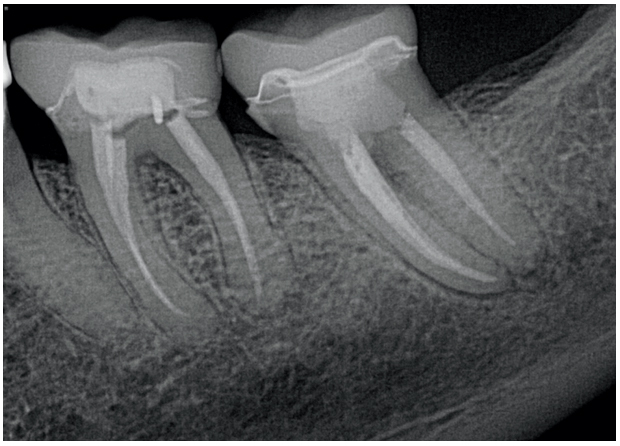 Снимок 1: Гребень № 18 перед удалением. Зуб удален и пересажен.