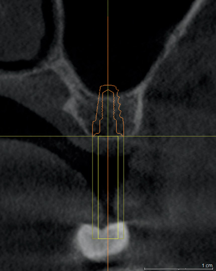 Снимки 10: имплантат 9 мм нарушают синус.
