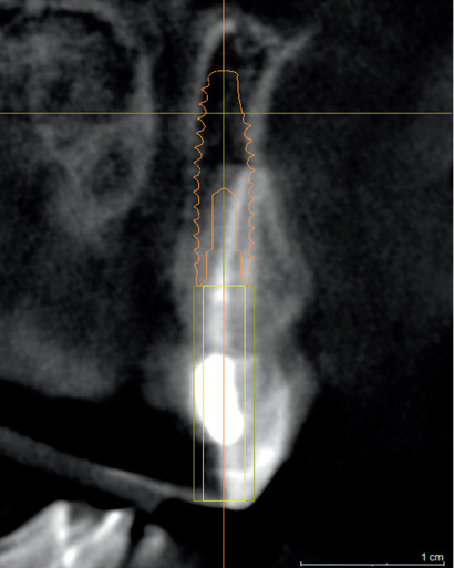 Снимок 13: Идеальная ширина имплантата 4,2 мм ставит под угрозу как щечную пластину, так и носонебный канал. 