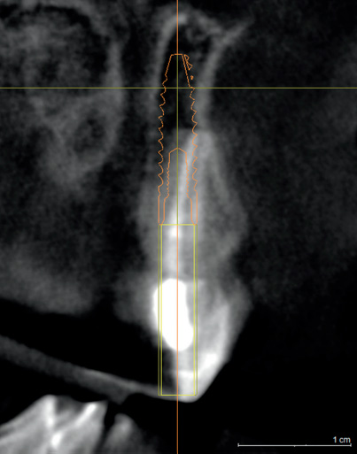Снимок 14: Имплантат изменился до ширины 3,4 мм, но даже при этом вероятен компромисс щечной пластинки или носонебного канала.
