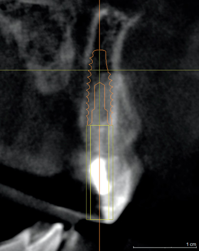 Снимок 15: Имплантат шириной 4,2 мм запланирован преднамеренно с нарушением носонебного канала и обходом щечной пластинки.