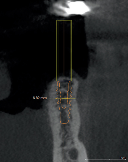 Снимки 7: Имплантат слева имеет ширину 4,6 мм и нарушает щечную пластину, имплантат 3,8 мм справа дает толщину щечной пластины >1,5 мм.