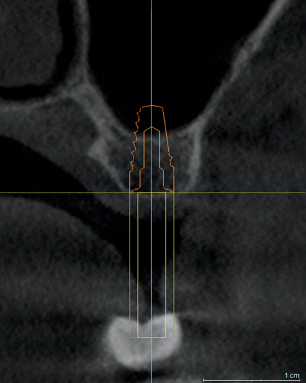 Снимки 9: имплантат 9 мм нарушают синус.