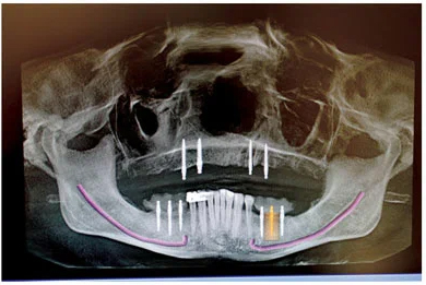 Планируемое расположение зубов хорошо видно для планирования установки имплантата
