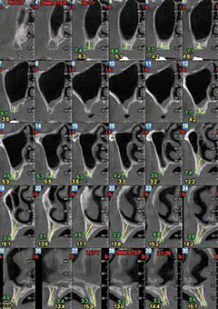 Конусно-лучевая компьютерная томография, показывающая недостаточный объем костной ткани в разных ракурсах.