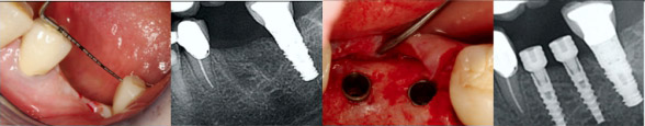 Замена моляра 2-мя зубными имплантатами узкого диаметра
