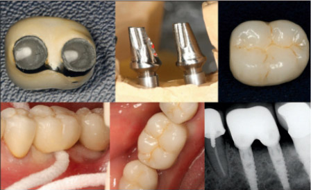 Замена моляра 2-мя зубными имплантатами узкого диаметра